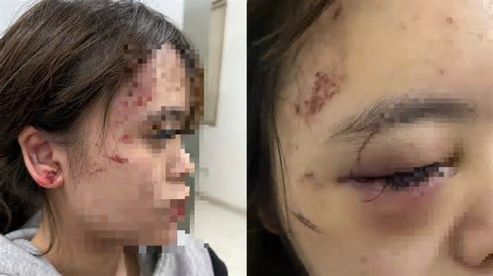 Buổi tối kinh hoàng của thiếu nữ 17 tuổi bị nhóm người đánh bầm dập, ép quỳ gối xin lỗi